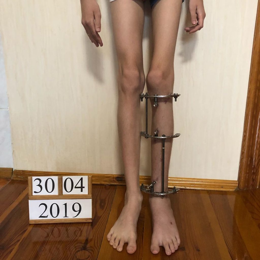 Результат коррекции длины ног с использованием аппарата Веклича
