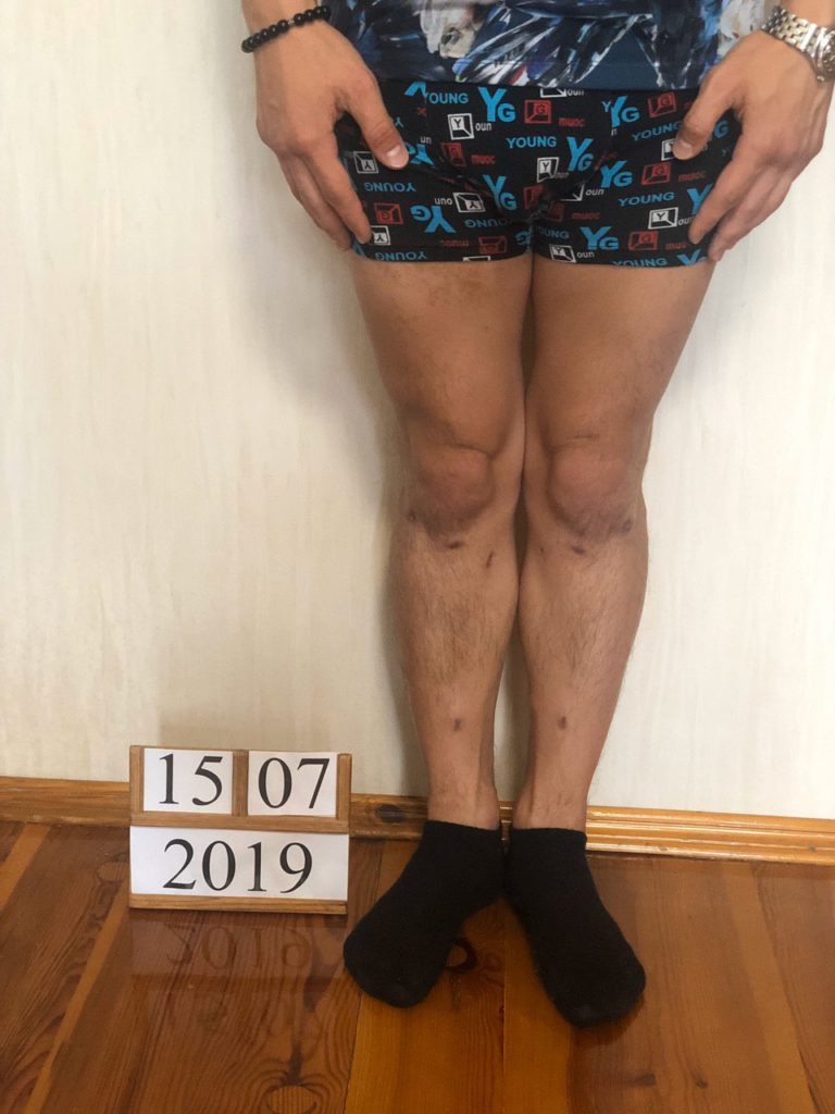 Результат коррекции варусной деформации ног аппаратом Веклича