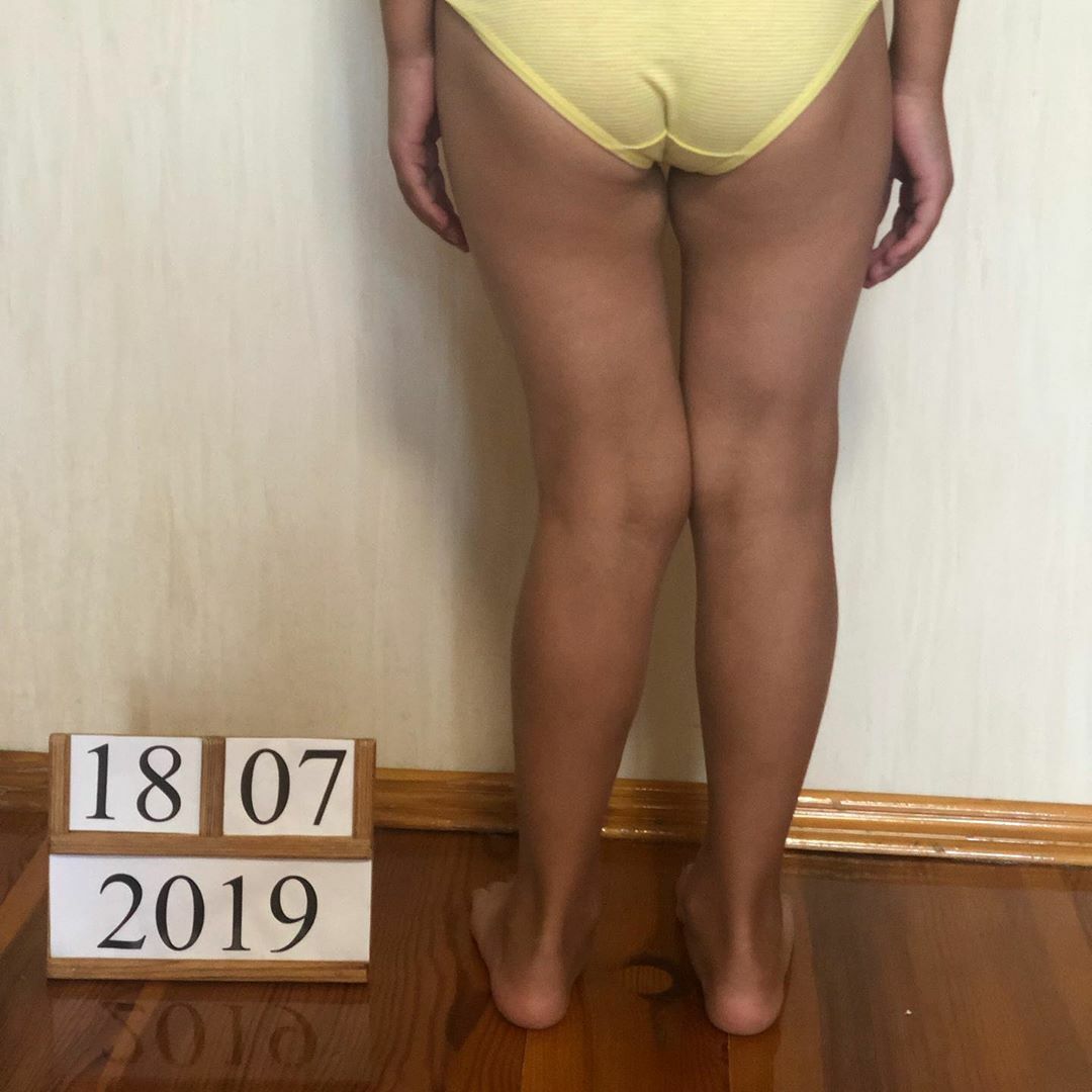 Коррекция ног иксом у ребёнка. Фото до и после — Ladisten