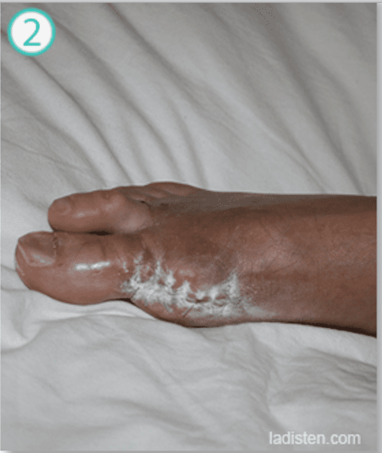 Коррекция вальгусной деформации правого пальца стопы