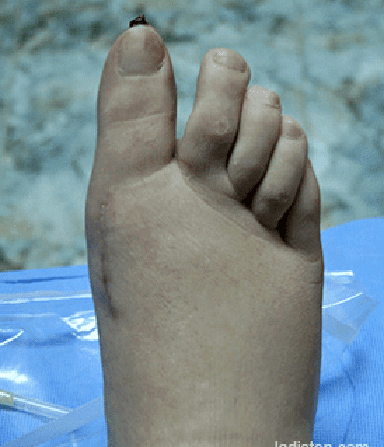 Лечение вальгусной деформации стопы