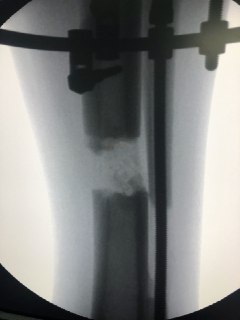 Удлинение ног. Рентген кости