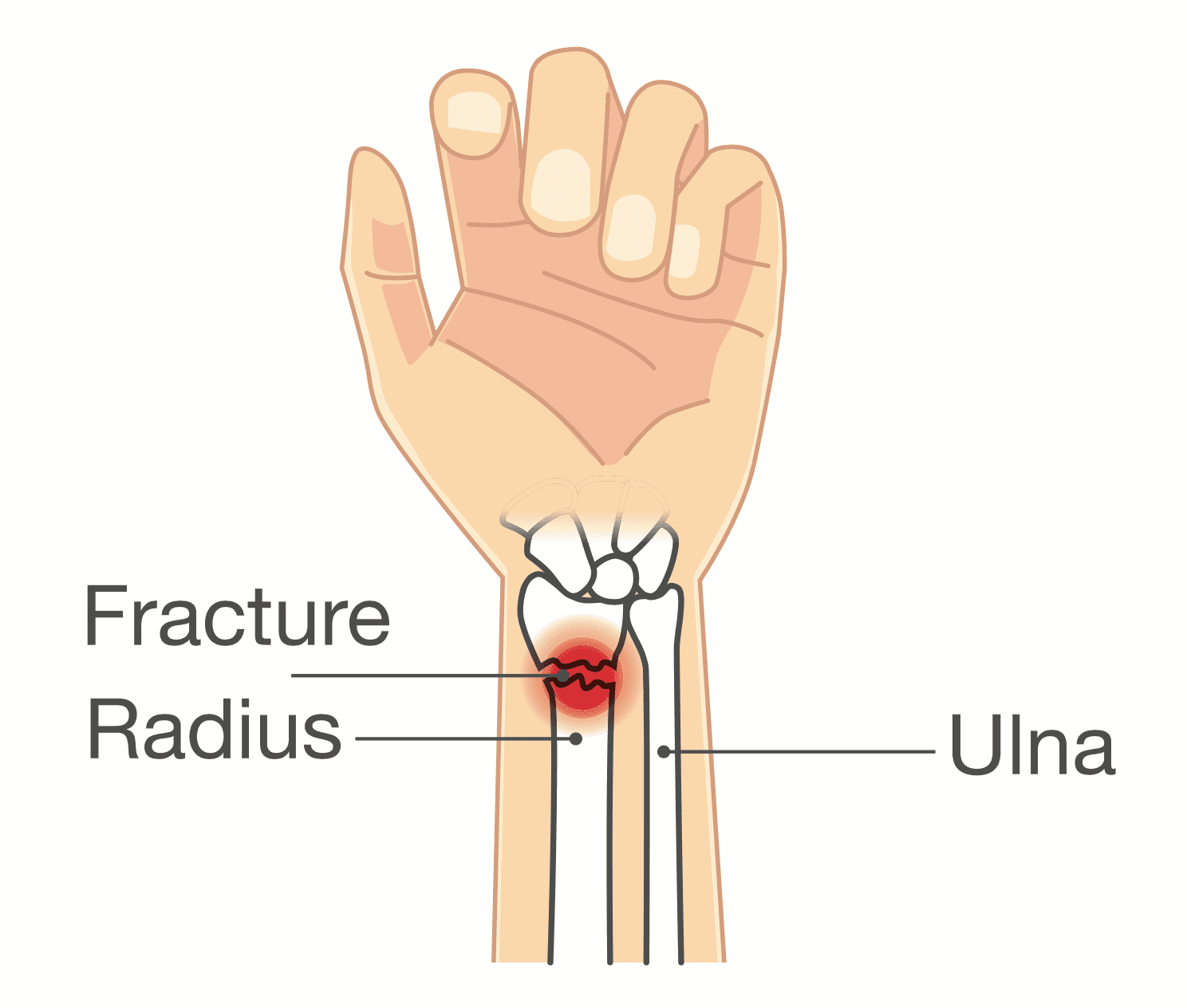 Distal radius fracture