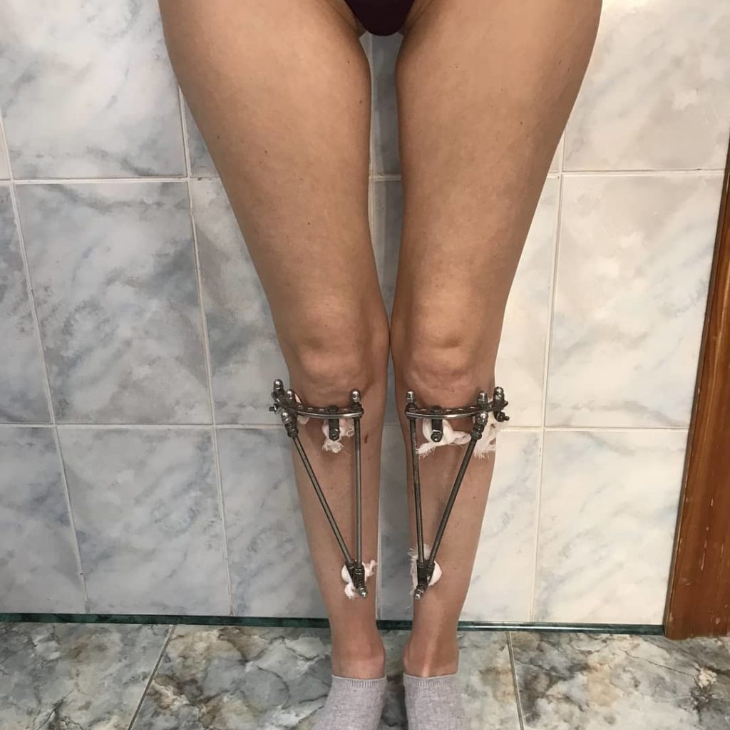 О-образные ноги после операции