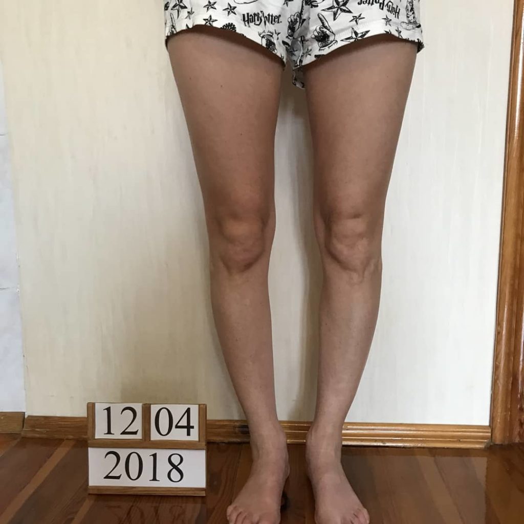 О-образные ноги до операции