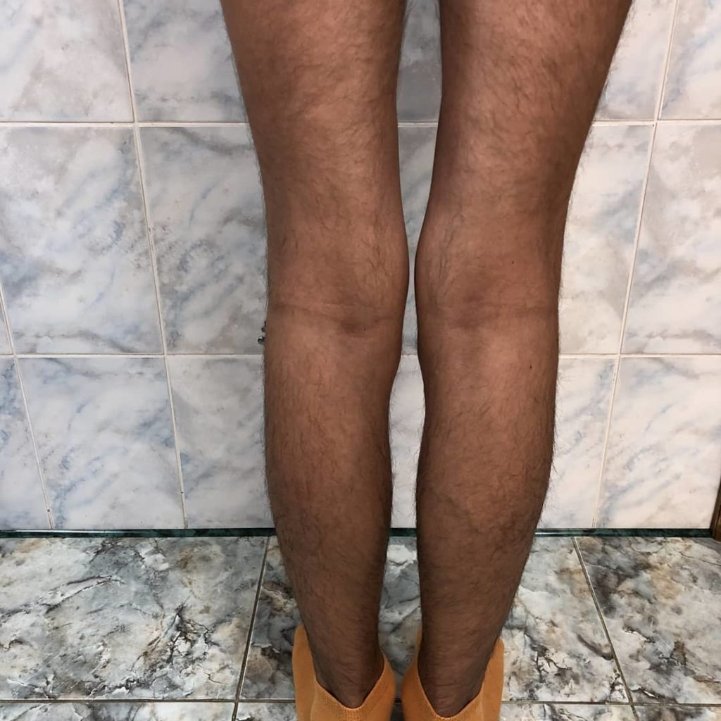 Выравнивание кривых ног у мужчины. Фото после