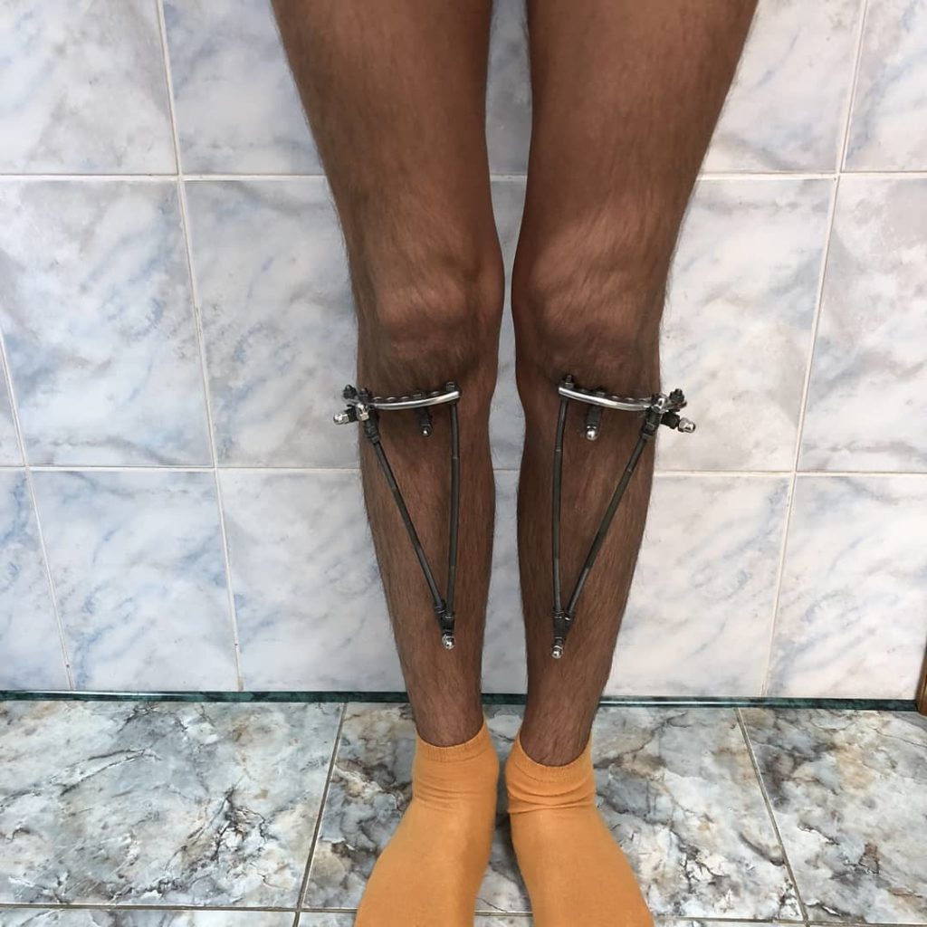 Выравнивание кривых ног у мужчины. Фото после