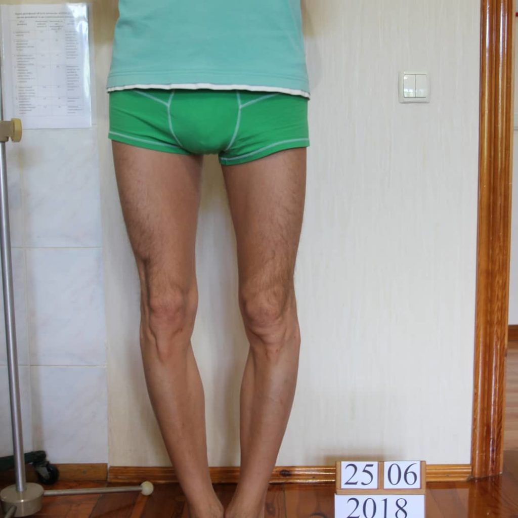 Выравнивание кривых ног у мужчины. Фото до