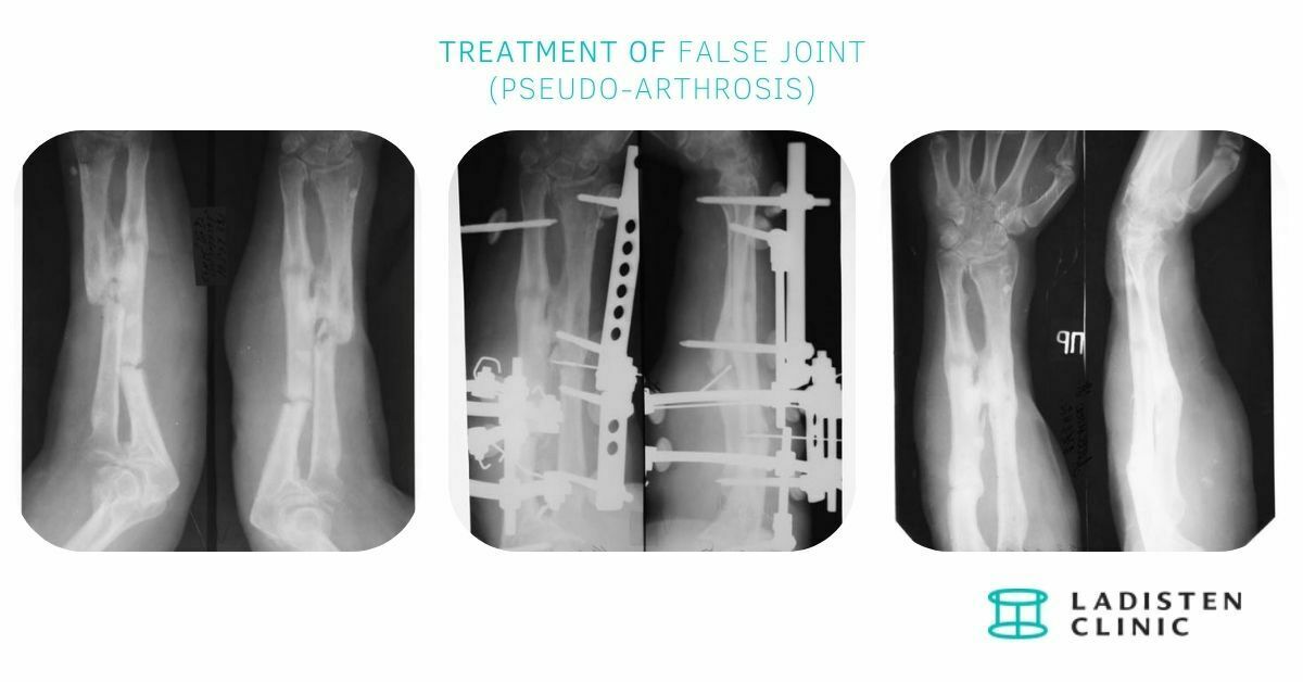 treatment of False joint (pseudo-arthrosis)